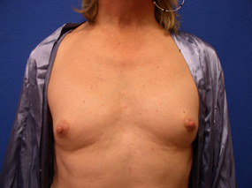 Transgender Breast Surgery