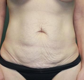 Tummy Tuck