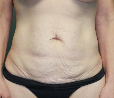 Tummy Tuck