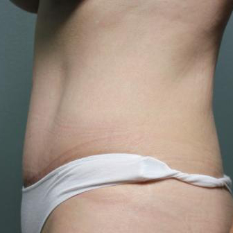 Tummy Tuck