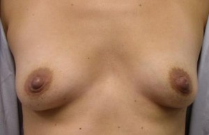 Breast Procedures