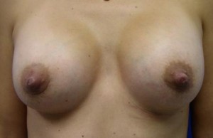 Breast Procedures