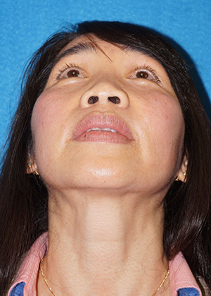 Rhinoplasty