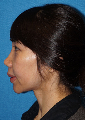 Rhinoplasty