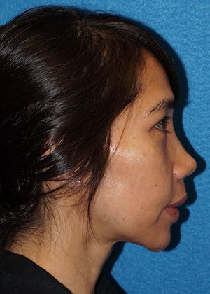 Rhinoplasty