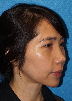 Rhinoplasty