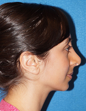 Rhinoplasty