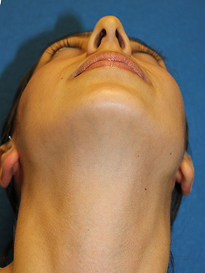 Rhinoplasty