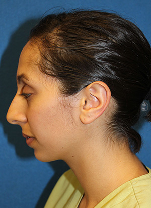 Rhinoplasty