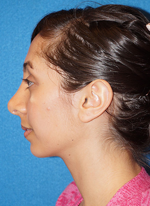 Rhinoplasty