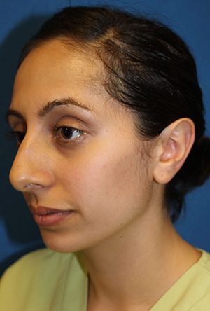 Rhinoplasty