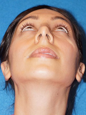 Rhinoplasty