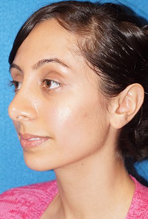 Rhinoplasty