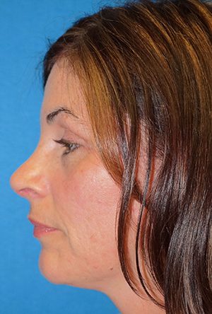 Rhinoplasty