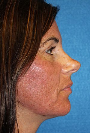 Rhinoplasty