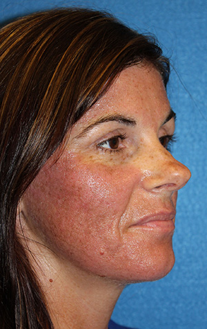 Rhinoplasty