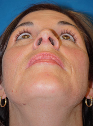 Rhinoplasty