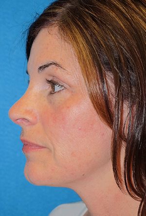 Rhinoplasty