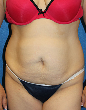 Tummy Tuck