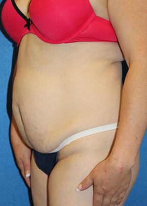 Tummy Tuck