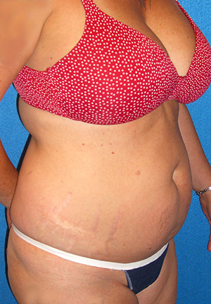 Tummy Tuck