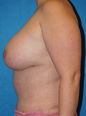 Breast Augmentation