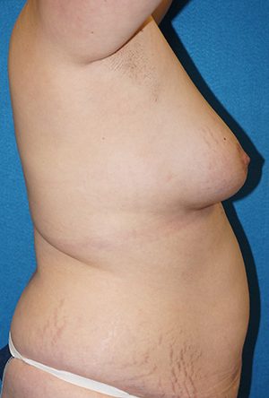 Breast Augmentation