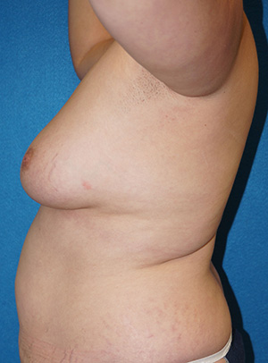 Breast Augmentation