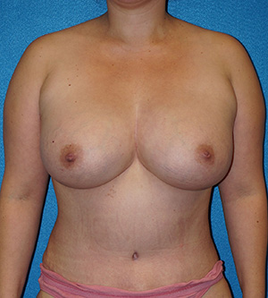 Breast Augmentation