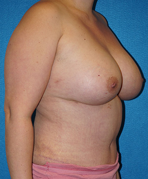 Breast Augmentation