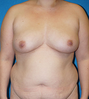 Breast Augmentation