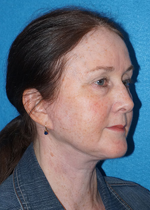 Facelift/Necklift