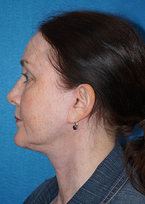 Facelift/Necklift