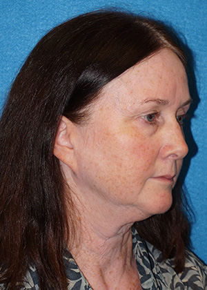 Facelift/Necklift