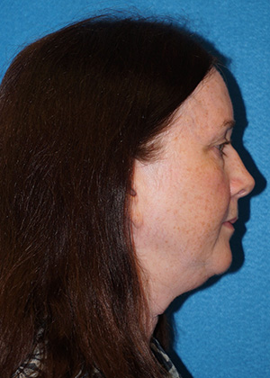 Facelift/Necklift