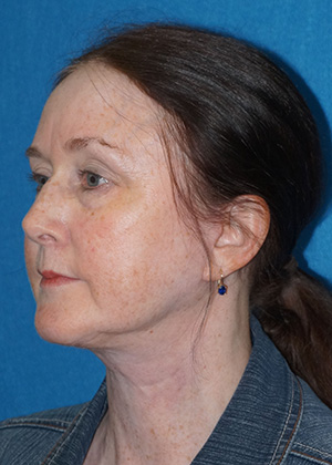 Facelift/Necklift