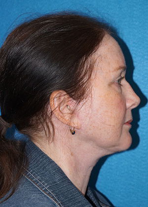 Facelift/Necklift