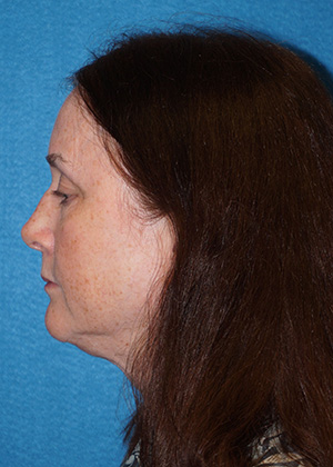 Facelift/Necklift