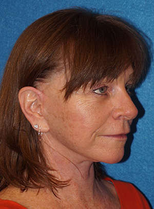 Facelift/Necklift