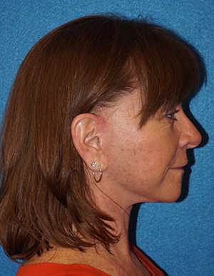 Facelift/Necklift