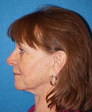 Facelift/Necklift