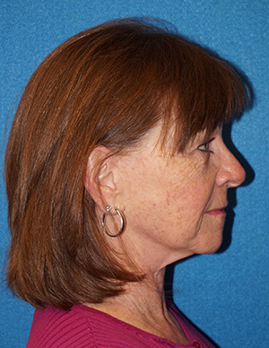 Facelift/Necklift