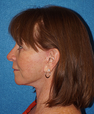 Facelift/Necklift