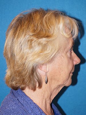 Facelift/Necklift