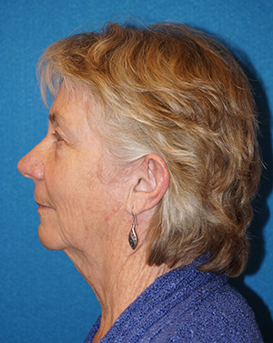 Facelift/Necklift