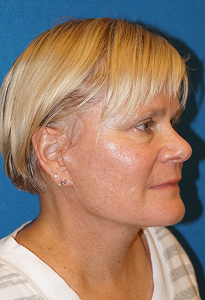 Facelift/Necklift