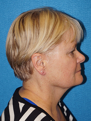 Facelift/Necklift