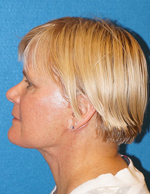 Facelift/Necklift