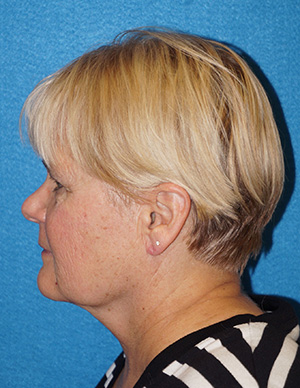 Facelift/Necklift