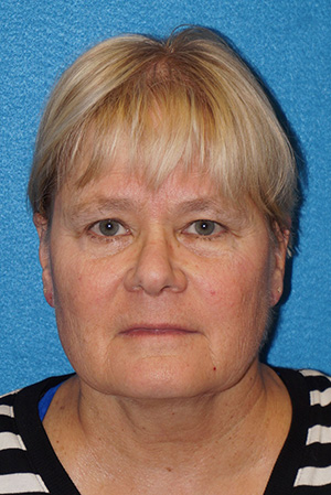 Facelift/Necklift